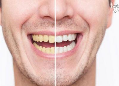 سفیدکردن دندان؛ از بلیچینگ تا لمینت
